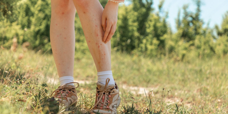 Piqûres de moustiques : l’astuce insolite d’une dermatologue contre les démangeaisons