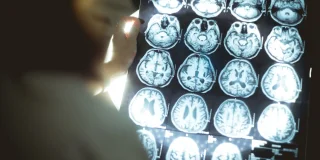 Des scientifiques japonais font une découverte immense sur la maladie d’Alzheimer